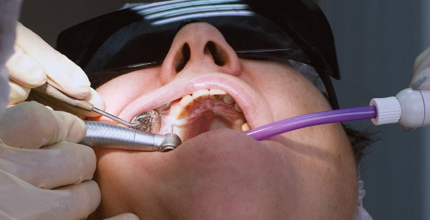 Cirugía de Implantes Dentales