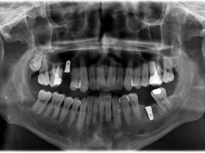 Estudio y Planificación - Implantes Dentales