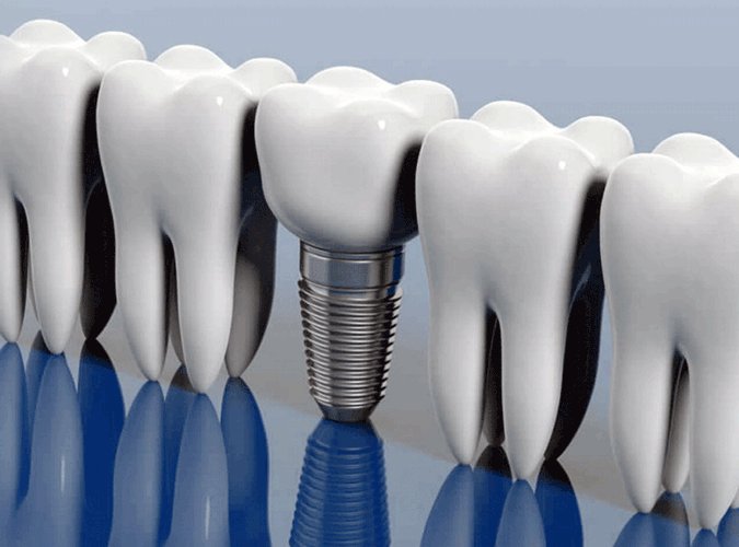 Que son los Implantes Dentales